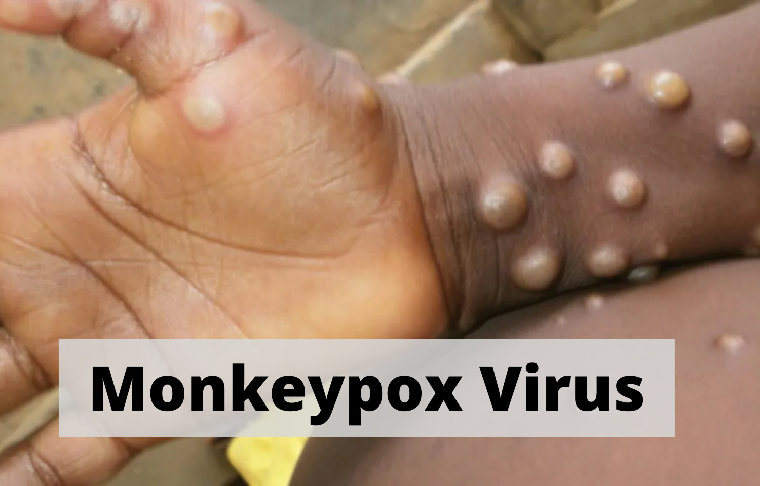 Monkeypox-virus-Newsstore24