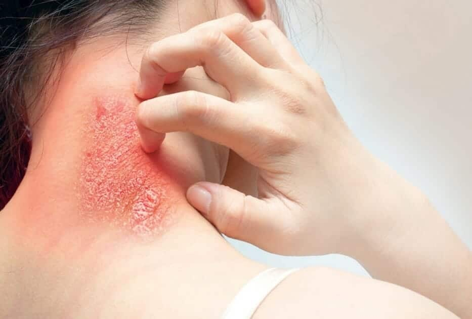 RISING FUNGAL INFECTIONS