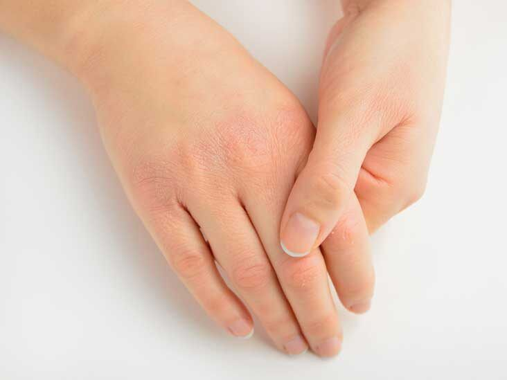 Blister