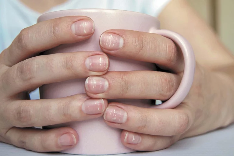 White Nails? It May Signal Health Issues!