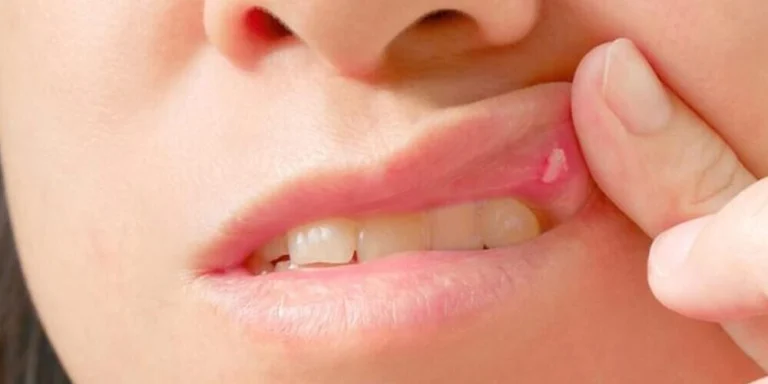 5 Natural Remedies for Quick Mouth Ulcer Relief